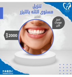 تنزيل مستوى اللثه  بالليزر (فكين)